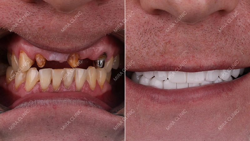 Before and After